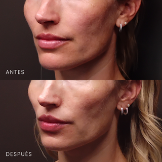 Láser CO₂ para Labios