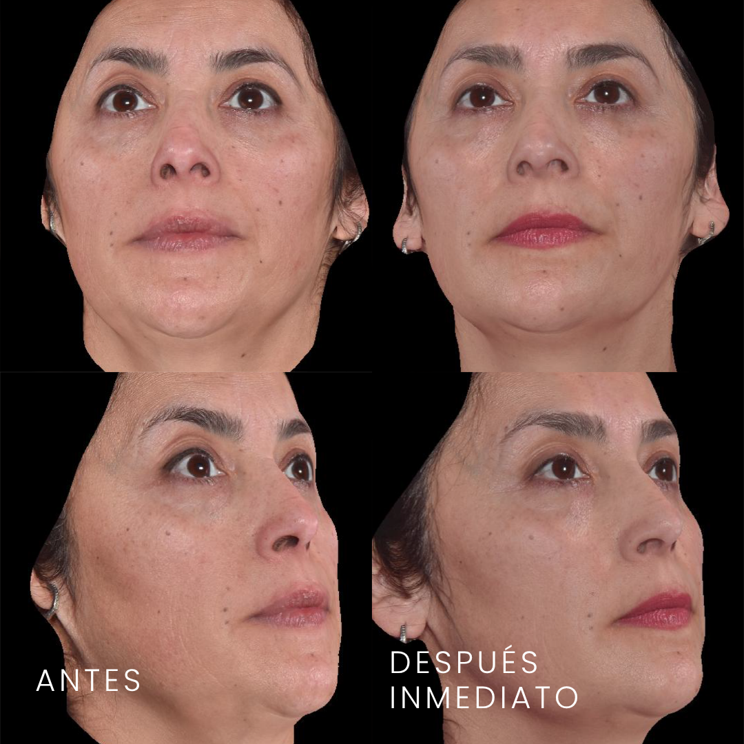 Antes y después de armonización facial con ácido hialurónico — perfilado mandibular y mentón