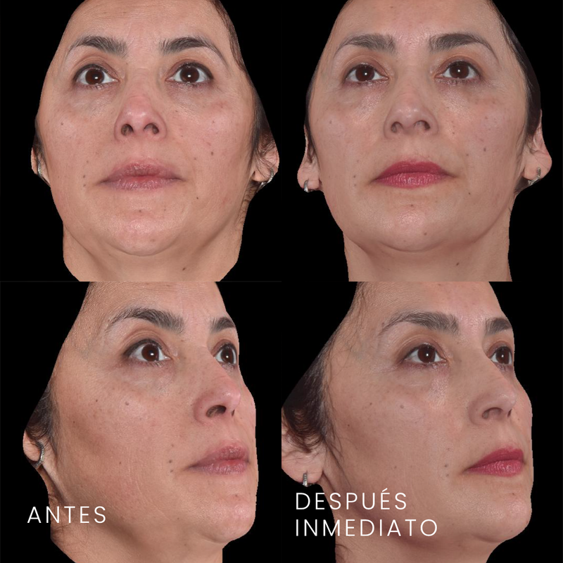 Antes y después de perfilado mandibular y mentón en mujer con ácido hialurónico