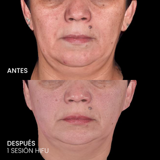 HIFU Liftera 2 Rostro completo y cuello + Evaluación médica