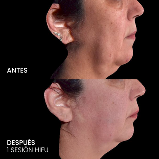 HIFU Liftera 2 Rostro completo y cuello + Evaluación médica