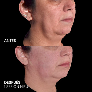 HIFU Liftera 2 Rostro completo y cuello + Evaluación médica
