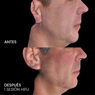 HIFU Liftera 2 Rostro completo y cuello + Evaluación médica