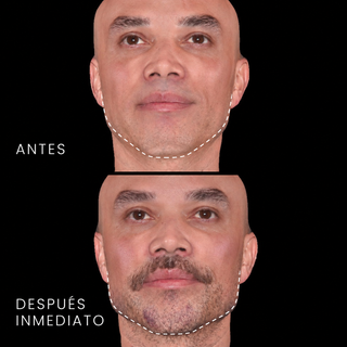 Perfilado Mandibular y Mentón con Ácido Hialurónico — Hombres (4 jeringas)