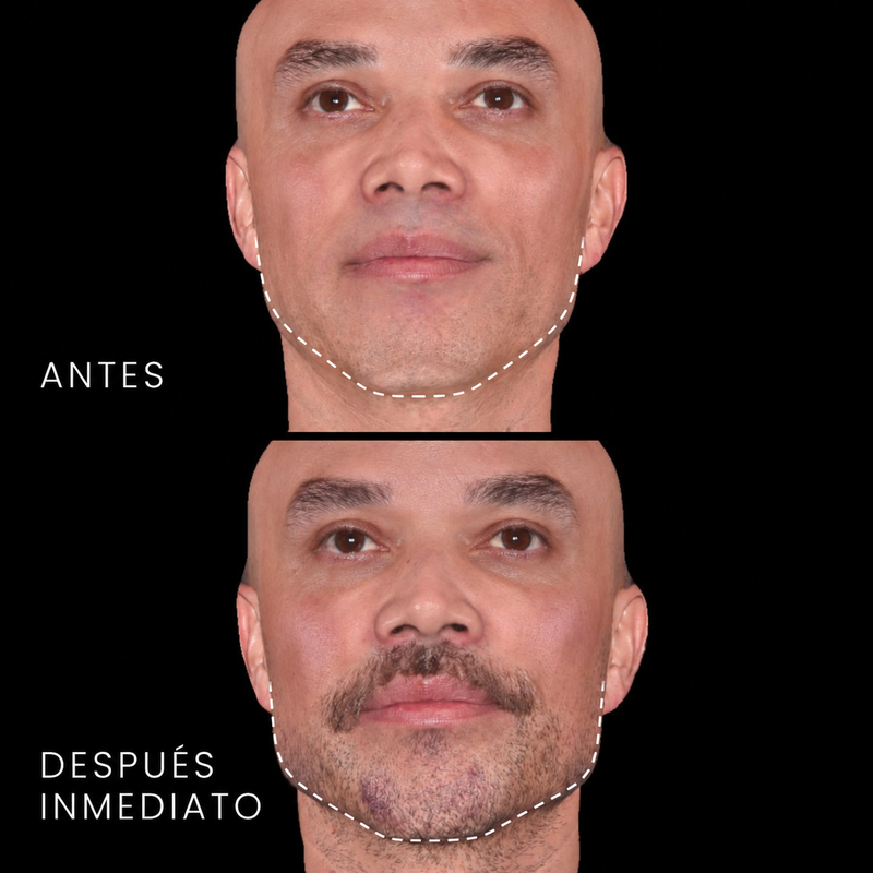Antes y después de perfilado mandibular y mentón en hombre con ácido hialurónico