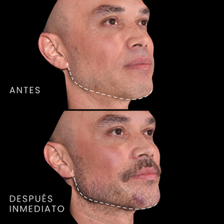 Perfilado Mandibular y Mentón con Ácido Hialurónico — Hombres (4 jeringas)