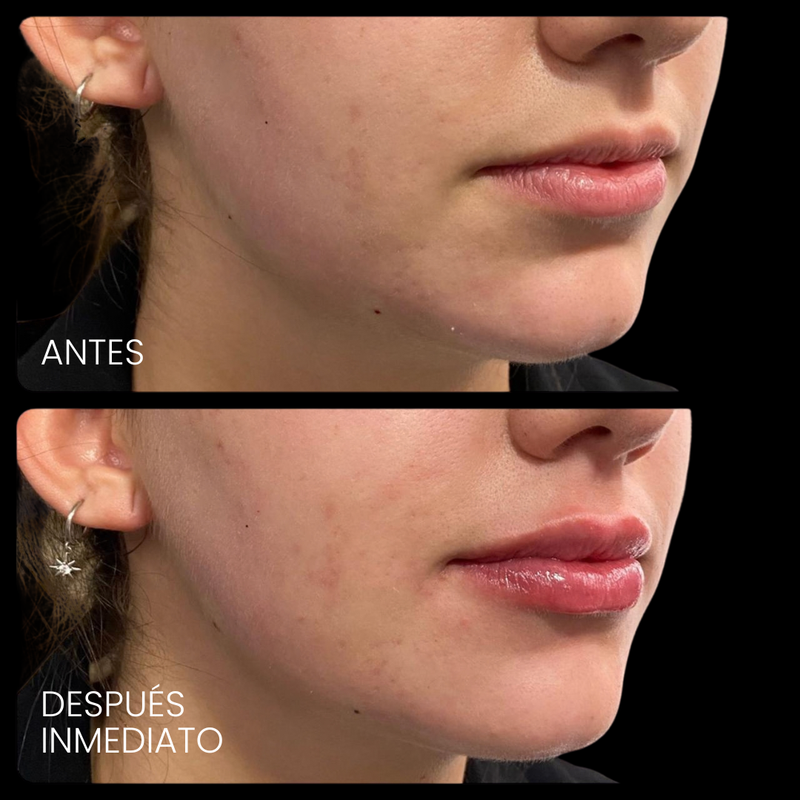Antes y después de relleno de labios con ácido hialurónico